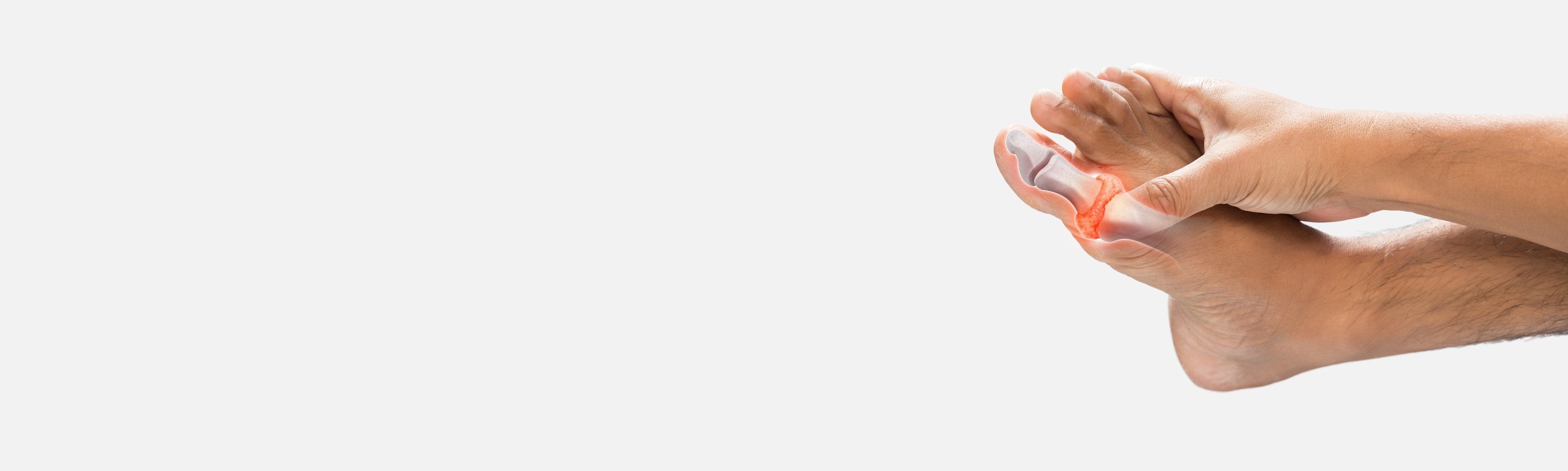 Why Is Gut Health Suddenly One of Gout Research’s Hottest Topics?