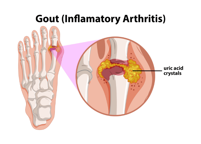 The Pain of Excess Uric Acid, and How to Fight it!